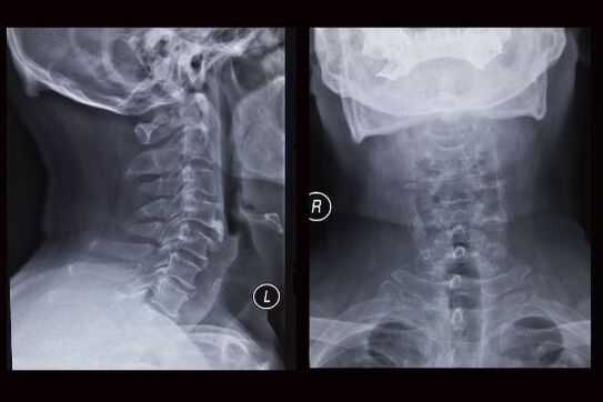 Imazhi me rreze X i shpinës së qafës së mitrës (pacienti ka osteokondrozë)