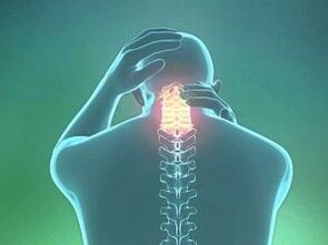 Një simptomë e osteokondrozës së qafës së mitrës është dhimbja e kokës