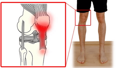 Tendiniti është një inflamacion i indit të tendinit që shkakton dhimbje në nyjen e gjurit. 