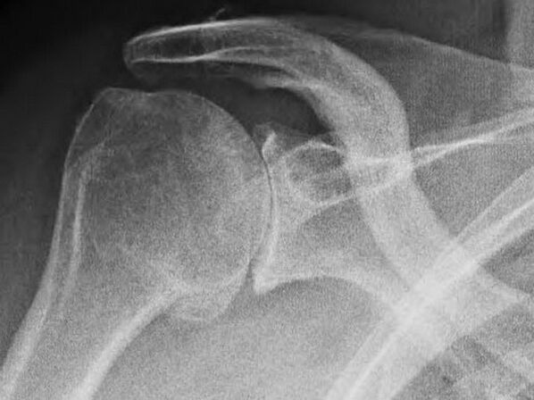 X-ray e një nyjeje të shpatullës së prekur nga artroza