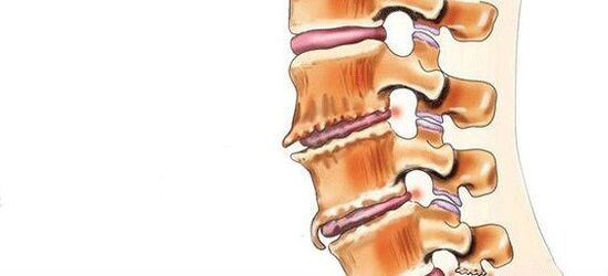 Spondiloza - shkatërrimi i nyjeve intervertebrale