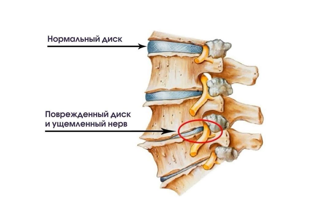 Simptomat e osteokondrozës së qafës së mitrës