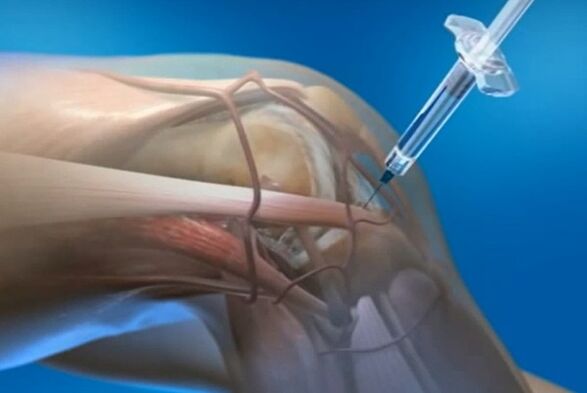 injeksione brenda artikulare për artrozën e nyjes së gjurit